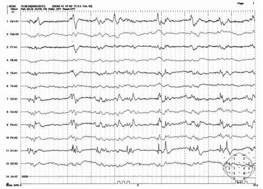 発作（右不全片麻痺、左への共同偏視、四肢・頸部に間代性けいれん）後まもなくの脳波：各誘導に左右差（左に徐波）あり