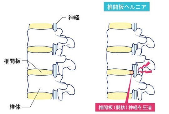［図表1］椎間板ヘルニアのしくみ