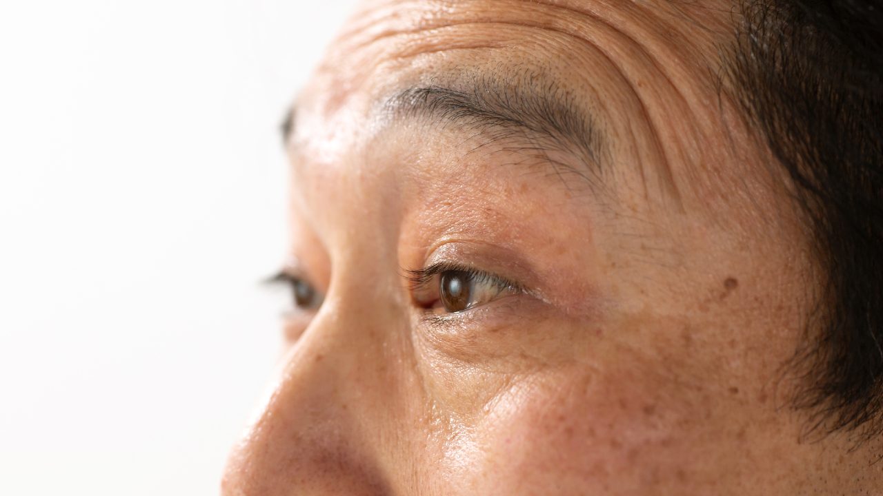 「目が開きにくい」眼瞼下垂…「コンタクトレンズ」も影響？「原因と治療法」を医師が解説