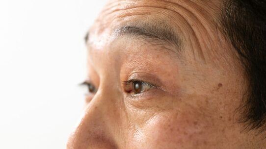 「目が開きにくい」眼瞼下垂…「コンタクトレンズ」も影響?「原因と治療法」を医師が解説