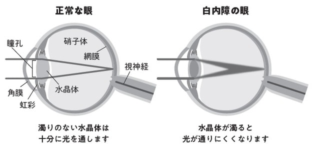 出典：白内障LAB「白内障とは」