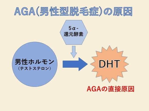 ［図表1］AGA（男性型脱毛症）の原因／(＜東京メモリアルクリニックHPより転載＞)