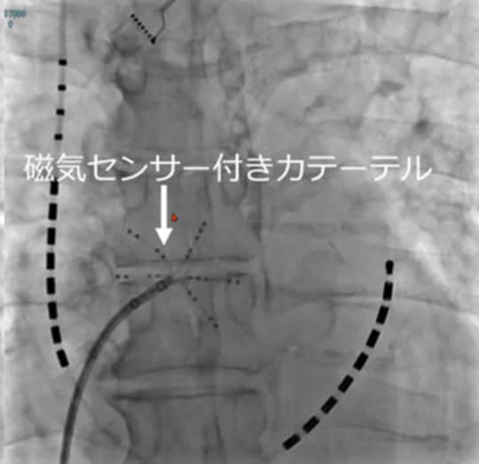 ［図表2］心臓のレントゲン写真