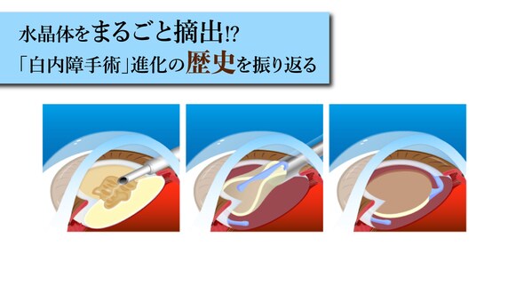 水晶体をまるごと摘出⁉「白内障手術」進化の歴史を振り返る