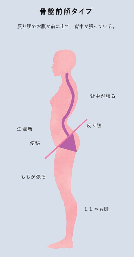 骨盤前傾タイプ