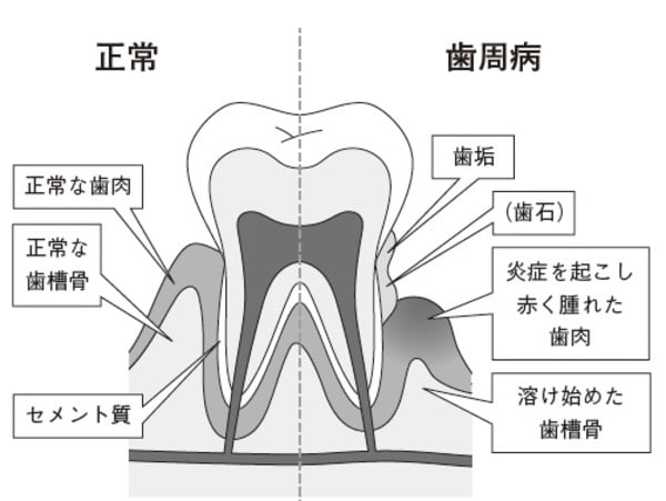 ［図表1］正常な歯肉と歯周病の歯肉