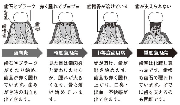 ［図表2］歯周病の進行
