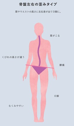 骨盤左右の歪みタイプ［図表8］
