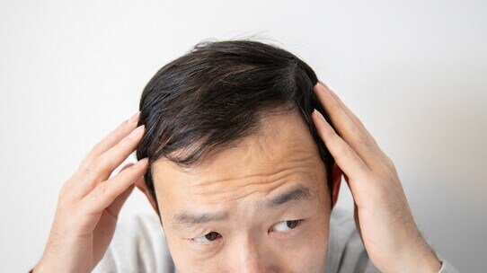 薄毛治療、効果が「実感できる人」と「できない人」の決定的な差【専門医が解説】