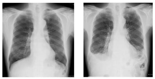 ［図表2］「アミオダロン」を服用して、間質性肺炎を引き起こした不整脈患者のレントゲン写真。右写真は白がかっている 提供：東京ハートリズムクリニック
