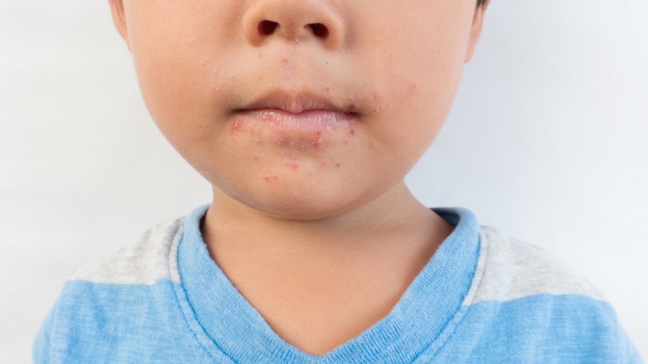 感染防御は極めて困難…コロナ禍の陰で急増している子どもの「厄介な病」【専門医が解説】