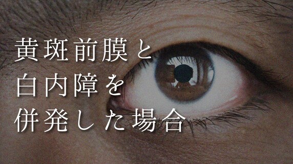 ものが歪んで見える「黄斑前膜」と白内障を併発…治療法は?