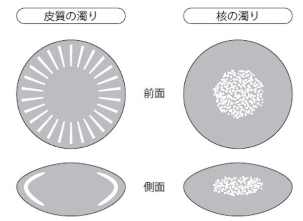 ［図表1］白内障の症状