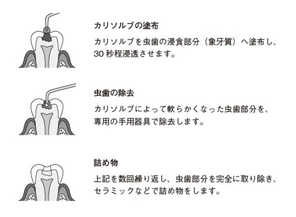 ［図表］カリソルブの治療