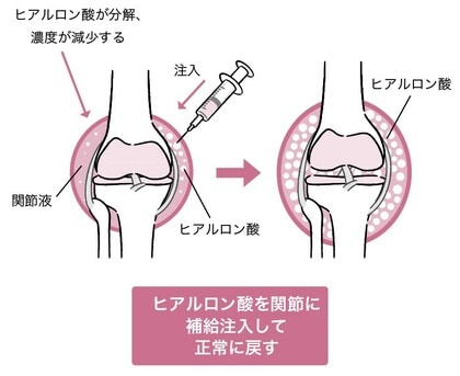 ［図表1］ヒアルロン酸注射