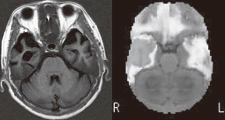 左：MRI像、右：脳血流SPECT像。60代女性。お金の計算もできて、買い物に行っても同じ物を買ってくることはない。夫の顔も覚えている。しかし「言葉が分からなくなった」と困っていた。頭部MRIでは両側（特に右側）の側頭葉に萎縮がみ られる。脳血流SPECT（3D-SSP）では明らかにその場所の血流が低下していた。アルツハイマー型認知症で特徴的とされる後部帯状回、楔前部の血流低下は認めない。この方は左利きなので、右側に言語機能があるようである