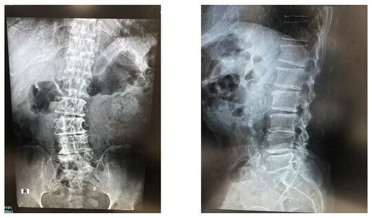 側面の画像（右）を見ると背骨のアライメントは悪くはないですが、正面の画像（左）を見ると変性側弯を認めました。