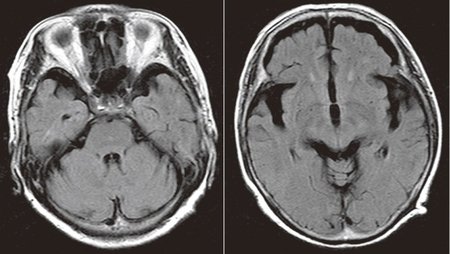 60代後半女性。2年前から記憶があいまいに。家事に無関心・無気力、肉じゃがを作れない。日にちが分からない。めまいがする。朝から起きていられない、ふらふらする。本やテレビを見ていると気分が悪くなってくる。HDS-R13点、MMSE13点。両側前頭葉および両側側頭葉の萎縮が目立つ。海馬の萎縮は認めない