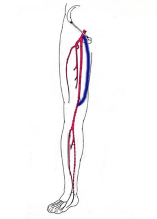 バイパス手術の一例