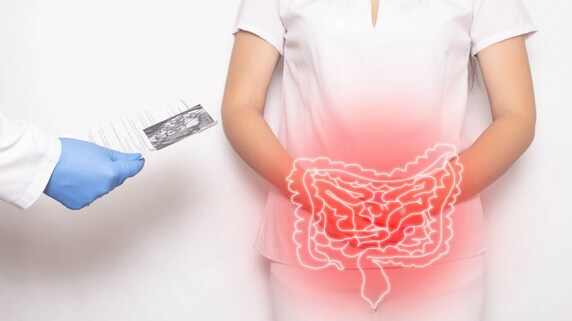 女性のがん、死亡率トップは「大腸がん」…女性が見逃しがちな“サイン”とは【消化器内科医が解説】