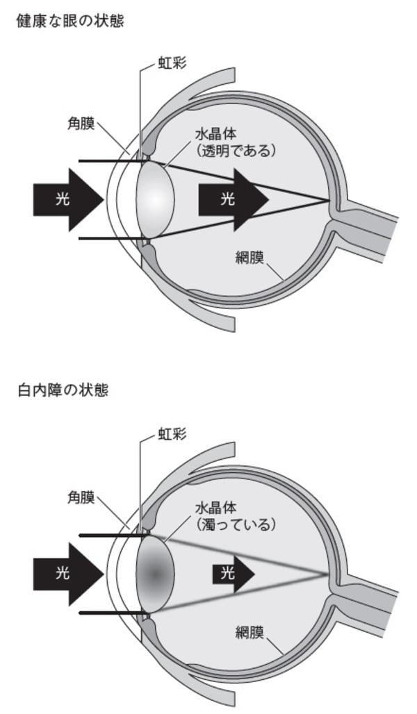 ［図表］白内障の状態