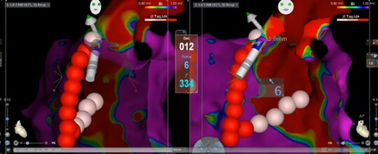 ［図表6］「コンタクトフォースアブレーション」で手術を行う様子