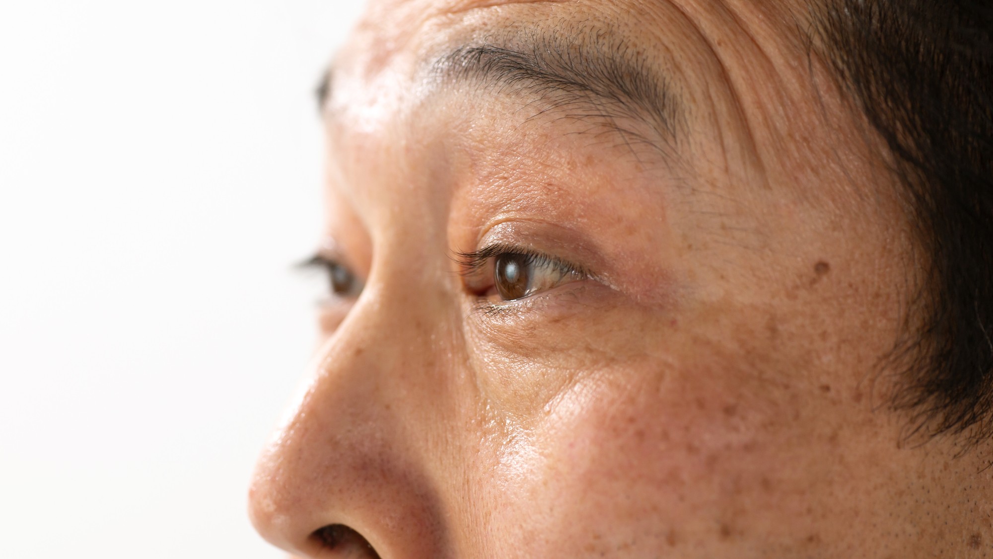 名医や専門医に「眼瞼下垂」と診断されても、保険診療でも「上瞼の全切開」（挙筋短縮・前転法）がNGな理由