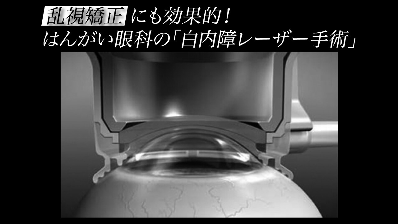 乱視矯正にも効果的!はんがい眼科の「白内障レーザー手術」