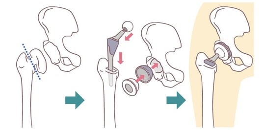 ［図表1］人工股関節置換術