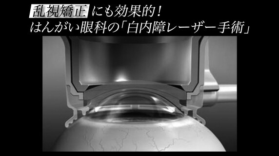 乱視矯正にも効果的!はんがい眼科の「白内障レーザー手術」