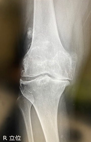 膝関節の内側(右側)の軟骨が摩耗し、すり減っている状態