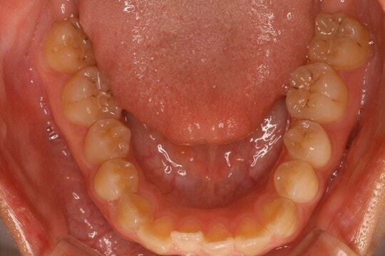 ［図表2］Ⅱ型の歯並び