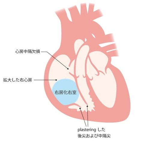 ［図表］エプシュタイン奇形