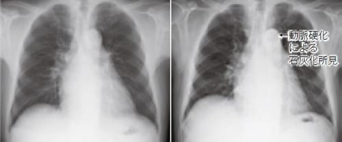 高血圧の治療が十分でなく、禁煙もできなかった。65歳で脳出血  右：2009年3月（57歳）（大動脈弓部には石灰化がない）、左：2017年3月（65歳）（大動脈弓部に石灰化がある）。
