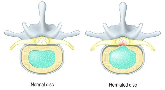 ［図表1］左：正常な椎骨／右：椎間板の中心にある髄核（ずいかく）が出てしまっている（「椎間板ヘルニア」の状態）
