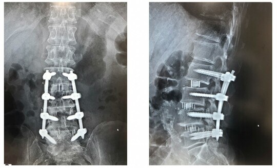 骨と骨のあいだにボックスが見え、後ろから金属で固定されている。