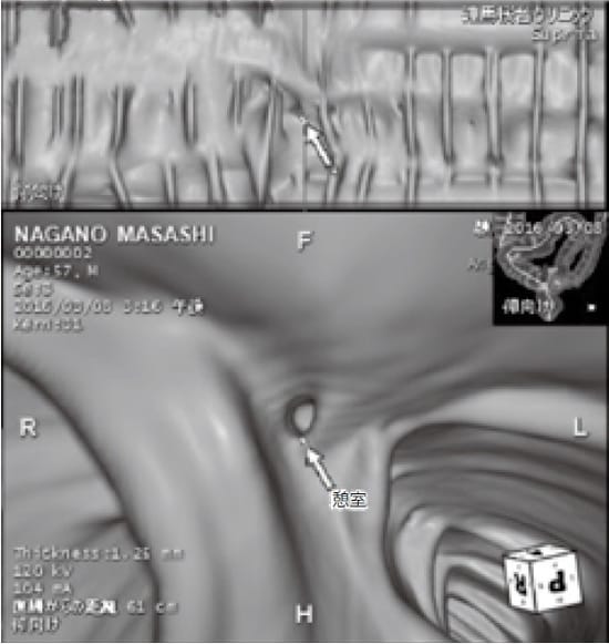憩室(大腸壁にできた袋)があることがよく分かる