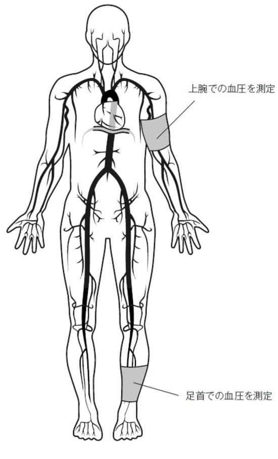 足関節上腕血圧比(ABI)を計算し、正常では足首の血圧が少し高値となるが、この比率が0.9以下の場合には動脈硬化が疑われる