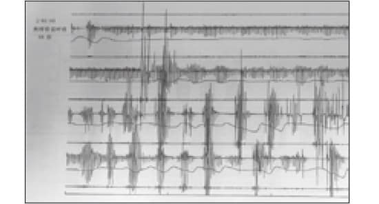 この検査では、睡眠時の無呼吸低呼吸指数は20.0回/時だった