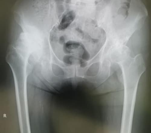 関節の隙間がなくなり、股関節の変形が進んでいる