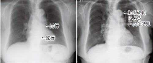 例① 　55歳から高血圧、脂質異常症の治療開始。糖尿病、他の生活習慣病には罹患していない。74歳時にはすでに大動脈の蛇行を認めるが、その後16年間で悪化していない。ただ、大動脈弓部に動脈硬化による石灰化所見が認められる  右：2003年3月（74歳）、左：2019年5月（90歳）
