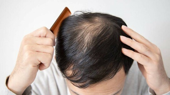 ストレスや食生活は無関係…「20代で薄毛の人」と「60歳でもフサフサの人」の差【専門医が解説】