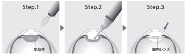［図表2］白内障手術のイメージ