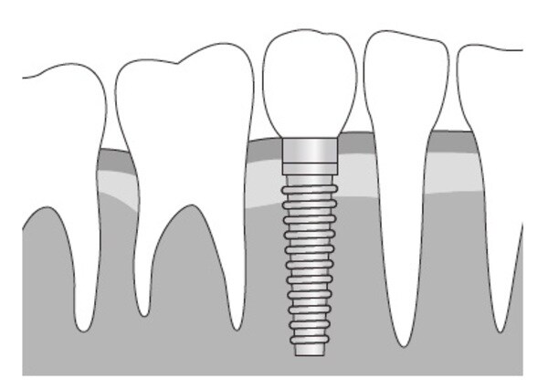 ［図表1］人工歯根