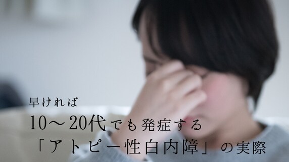 早ければ10〜20代でも発症する「アトピー性白内障」の実際