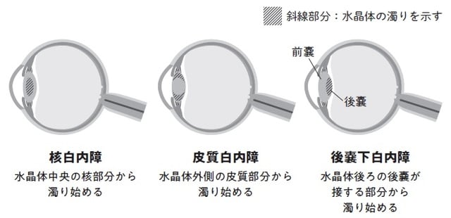 出典：白内障LAB「白内障の種類」