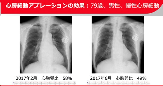［図表9］心房細動アブレーションの効果：79歳、男性、慢性心房細動