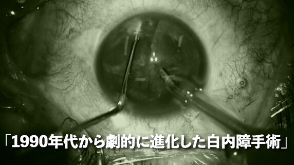 「手探り」で麻酔注射…1990年代まで行われていた白内障手術