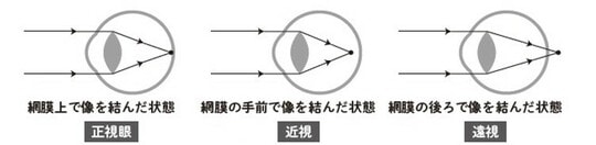 ［図表1］正視眼・近視・遠視の眼球の比較