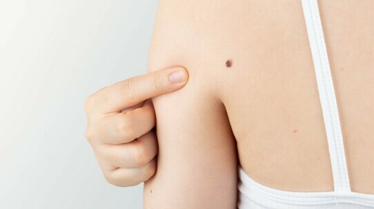 「ほくろ」みたいにみえる皮膚がん…注意すべき点と見分け方